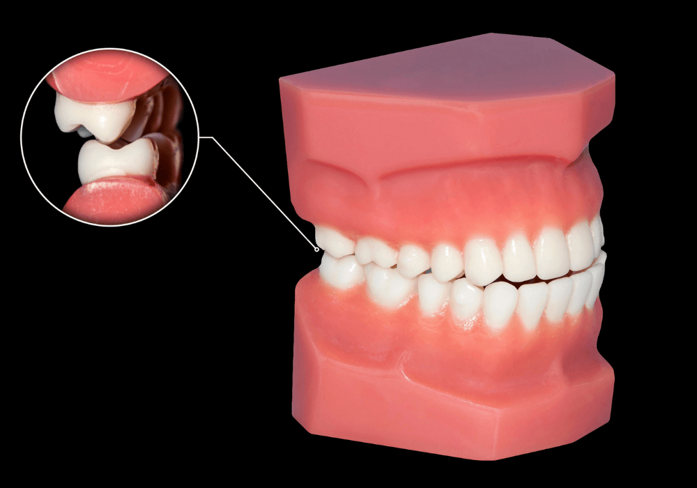 What Is Tooth Grinding? Causes, Dangers, and How to Stop It at Night