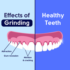 Diagram demonstrating the impacts of grinding on your teeth, vs healthy teeth